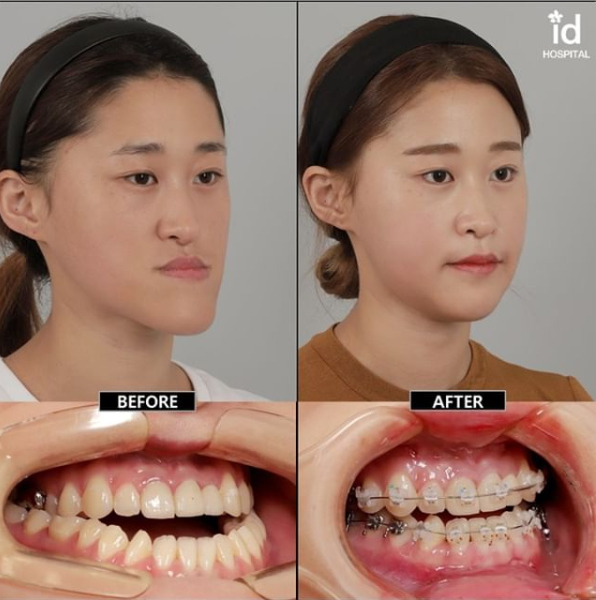【爆笑】TikTokerさん、世界で最も整形してる国ランキングの動画をアップし韓国人を発狂させてしまう\n_4