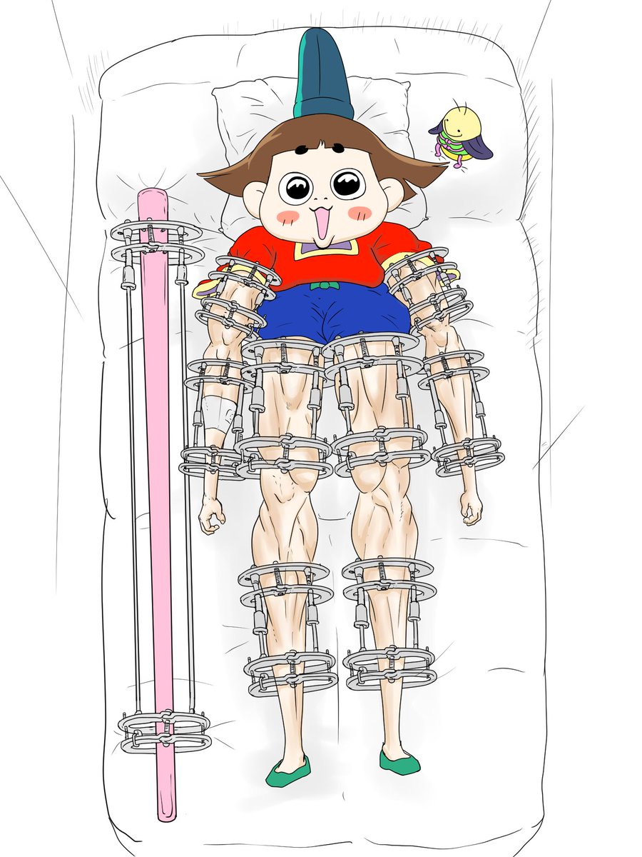 【爆笑】骨延長した奴ら、全員不幸になっていたwwwwwwwwwwwwwwwwwwwwwwww\n_1
