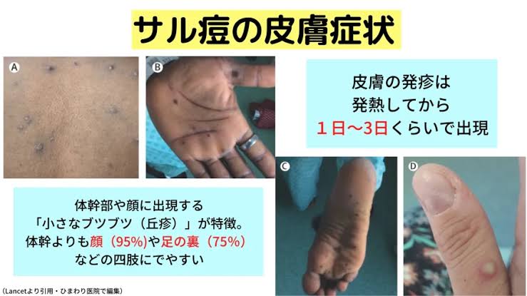 ワイ、３期梅毒と診断されてしまう・・・・バラ疹っていうのが内臓にも発生しているらしい  [898018687]
_40_40